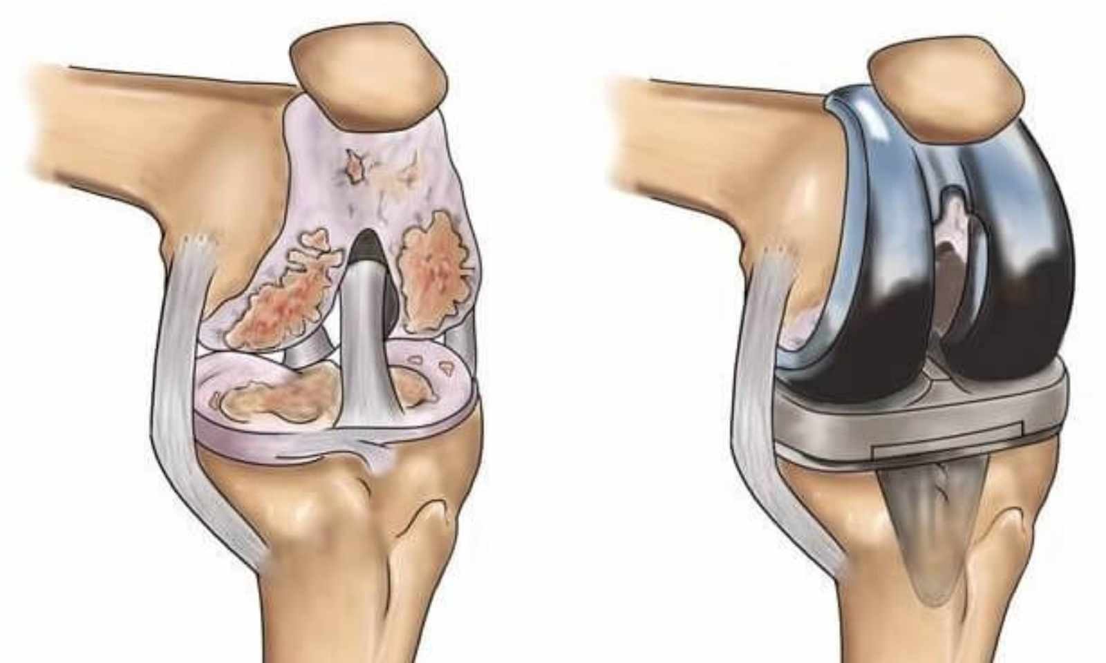 Best Knee Replacement Surgeon