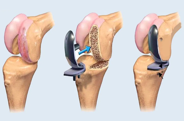 Knee Replacement Surgery