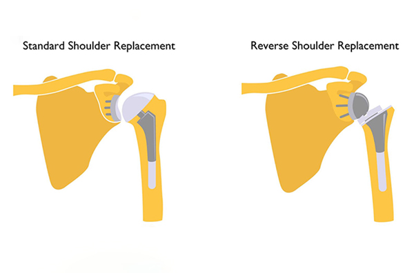 Reverse Shoulder Replacement