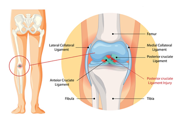 Knee Ligament Surgery