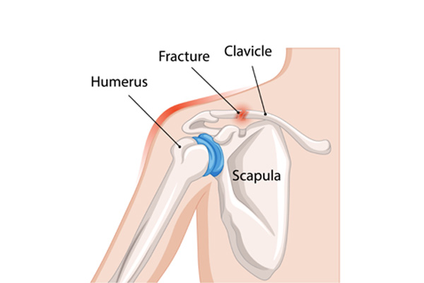 Recurrent Shoulder Dislocation Surgery